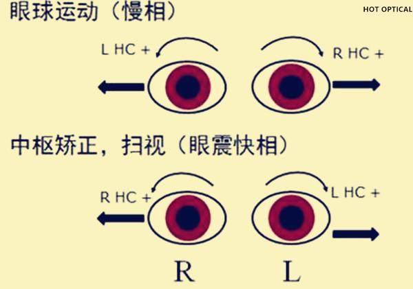 眼球震颤最新治疗方法的研究与进展，创新疗法探索及进展概述